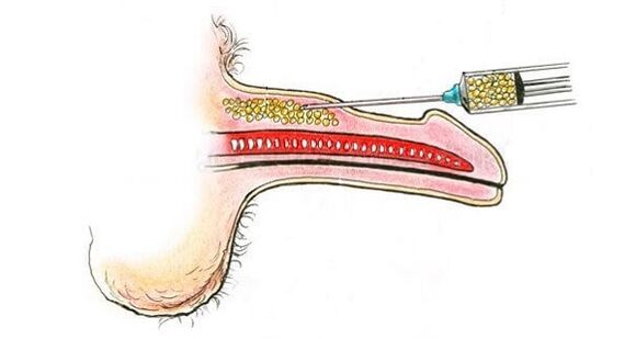 Hyaluronsäure -Injektionen in der Kanone eines Mitglieds, um sie zu erhöhen